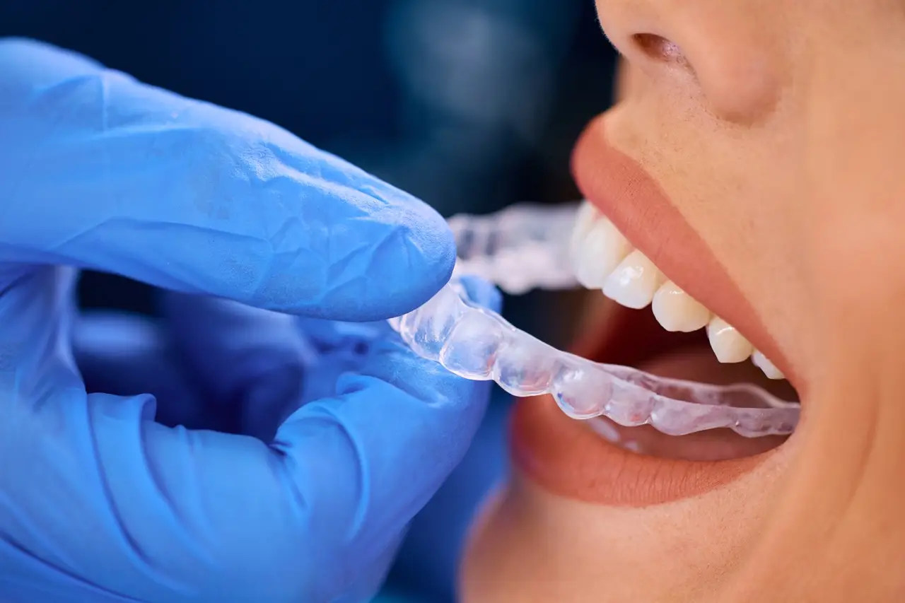 Close up of stomatologist placing invisible dental aligners on woman's teeth.