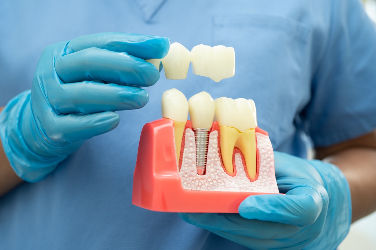 Dental implant, artificial tooth roots into jaw, root canal of dental treatment, gum disease, teeth model for dentist studying about dentistry.